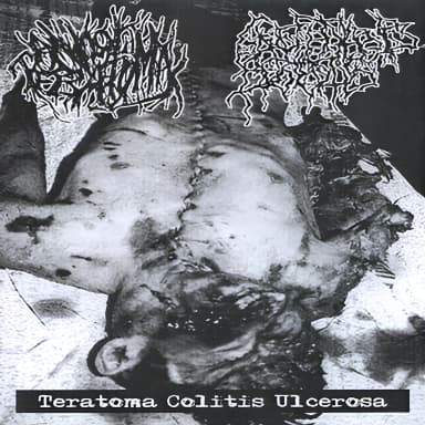 Teratoma Colitis Ulcerosa