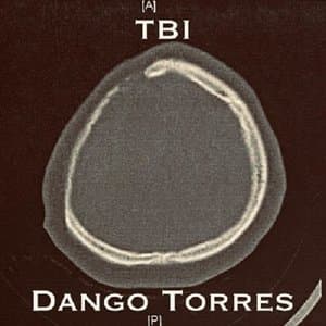 TBI